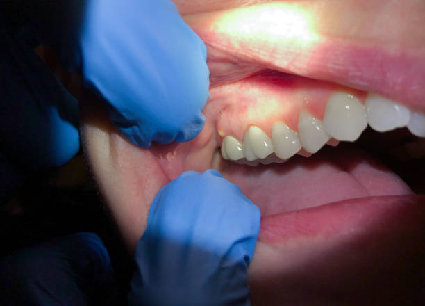 Best Tooth Infection Emergency Dentist  in Mcqueeney, TX