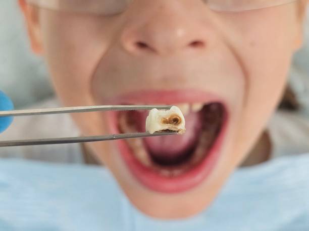 Best Dentist for Tooth Abscess  in Mcqueeney, TX